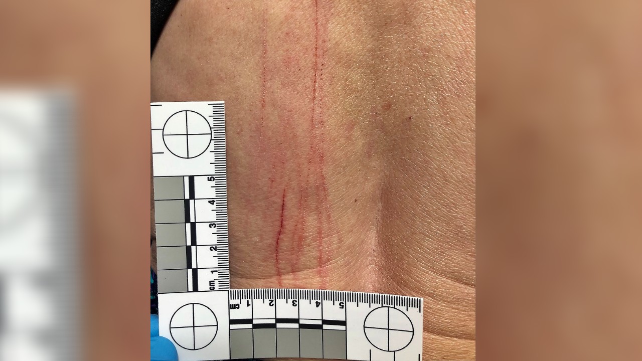 Woodland Park woman attacked by deer