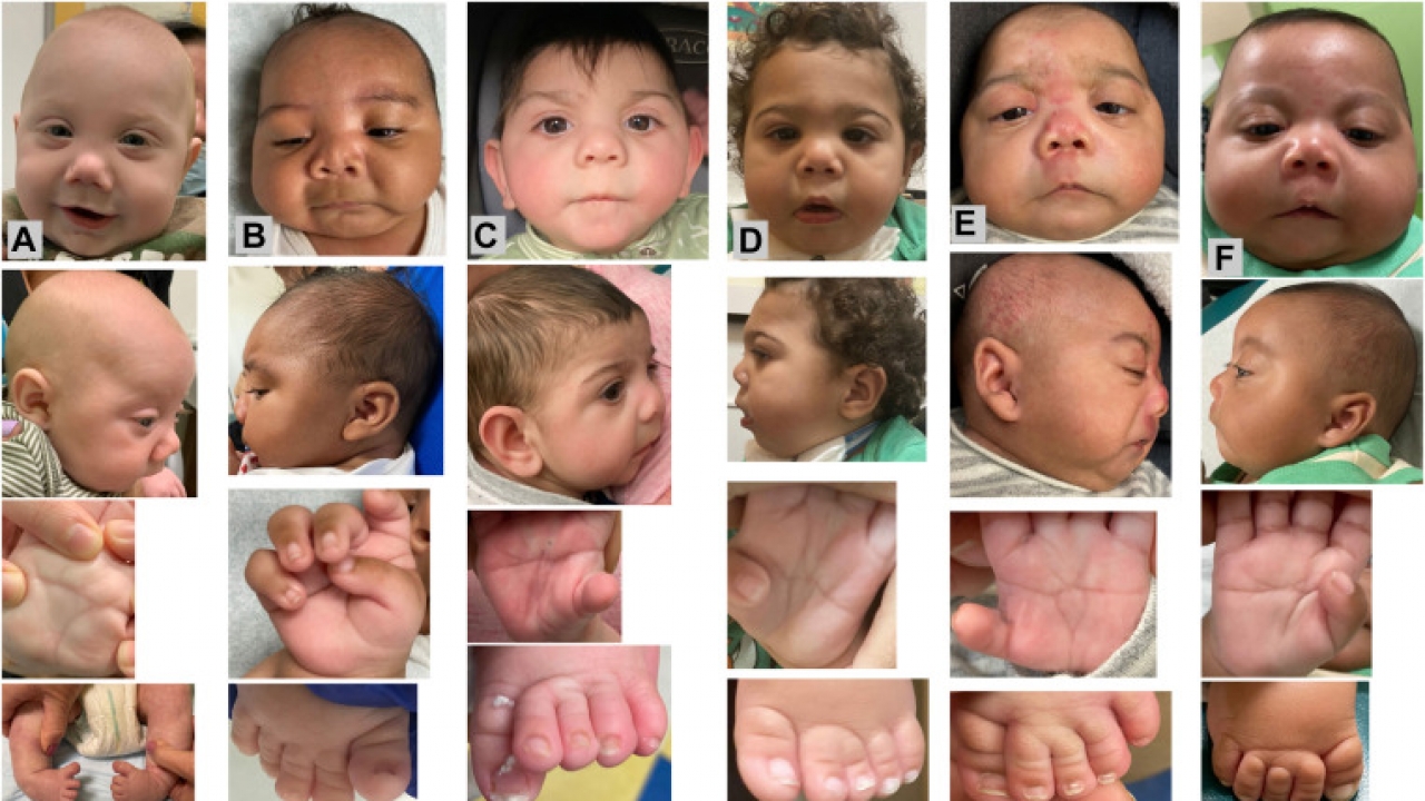 Babies studided as part of a prenatal fentanyl exposure syndrome report are shown.