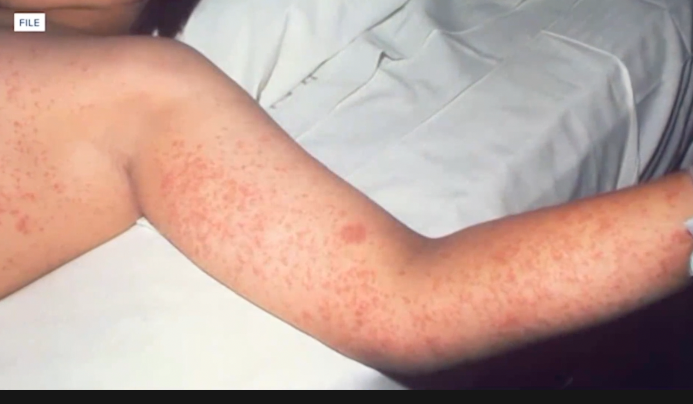 Measles on the rise in the South, causes preparation in West Michigan