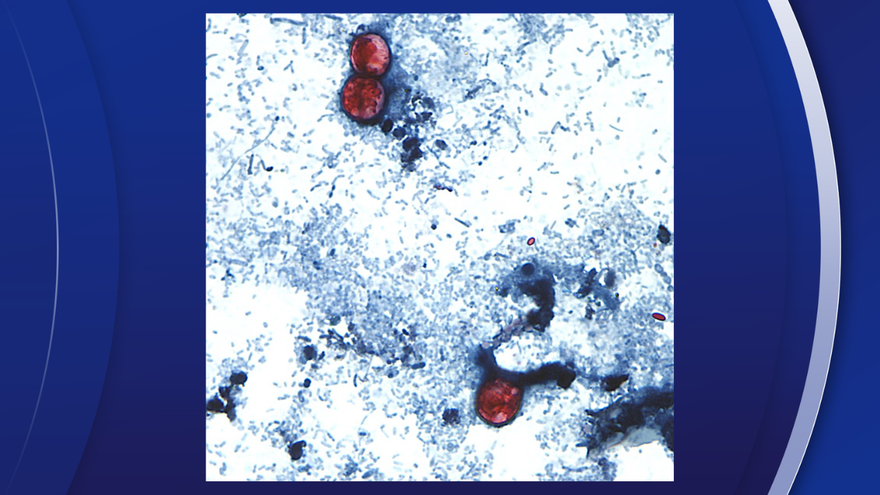 This undated photo taken through a microscope provided by the CDC shows Cyclospora cayetanensis oocysts found in a fresh stool sample which had been prepared with a formalin solution and stained with safranin.