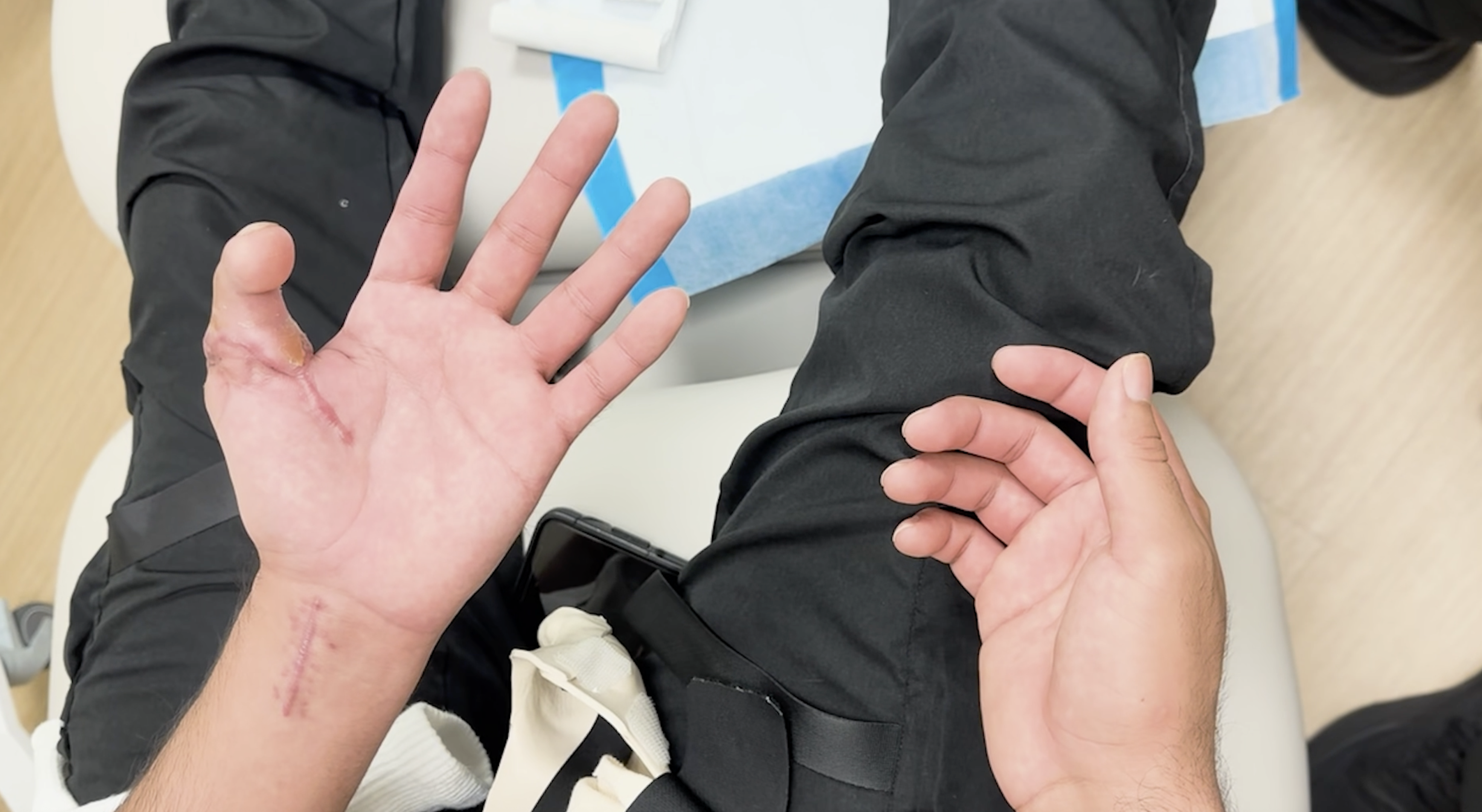 Sentara surgeon replaces patient's severed thumb with toe