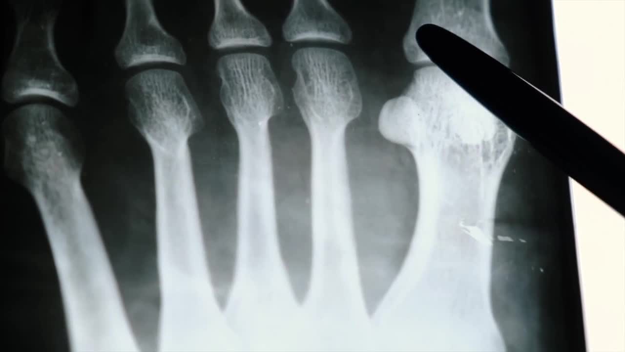 Caring for you bones as you age is easy, but don't expect the bones of a teenager.