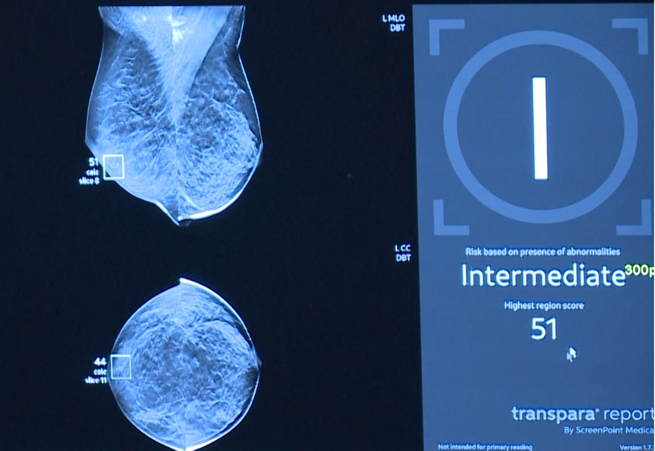 Riverside Health System to use artificial intelligence in breast cancer screenings
