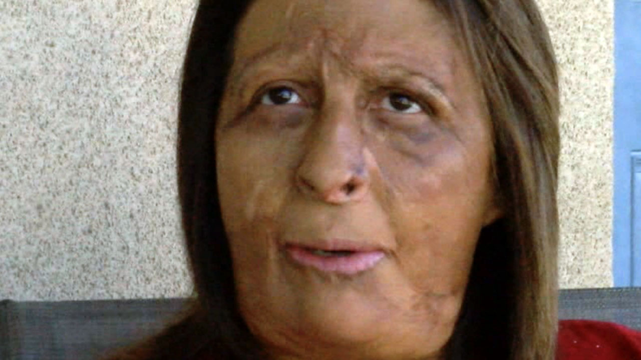 tierrasanta burn victim.jpg