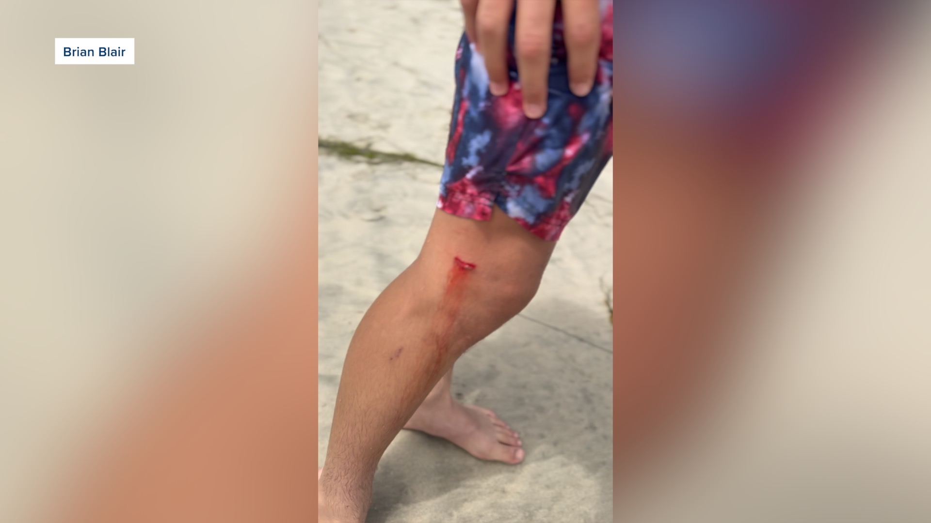 A 14-year-old boy was bit by a sea lion while swimming in Del Mar on the Fourth of July