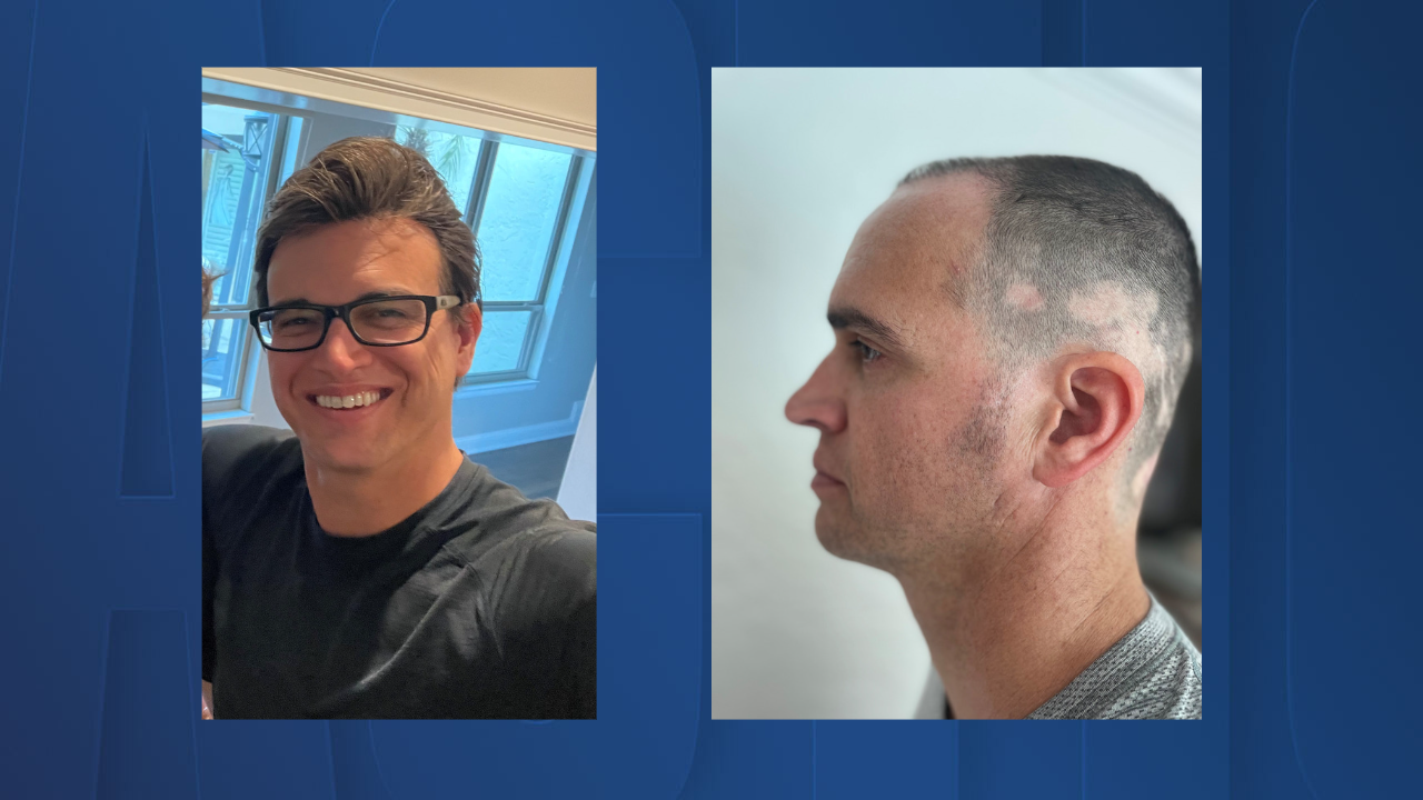ABC Action News Anchor Paul LaGrone details his fight against alopecia areata