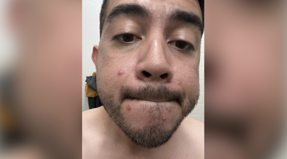 College Area man, Comic-Con volunteer calls monkeypox battle 'scary and painful'