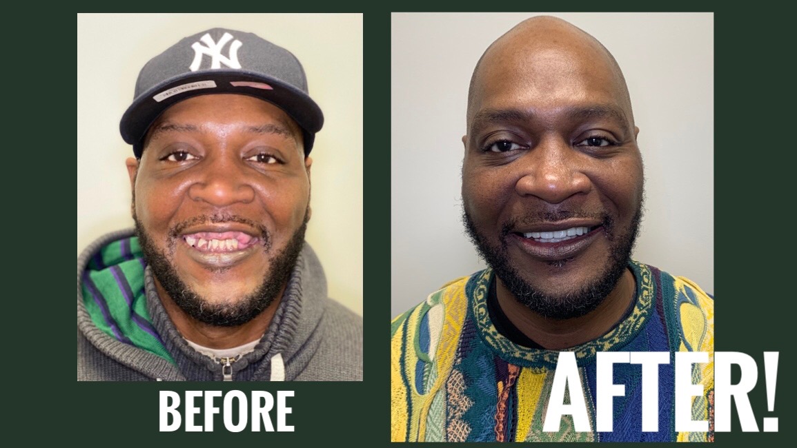 SMILE AGAIN BEFORE AND AFTER