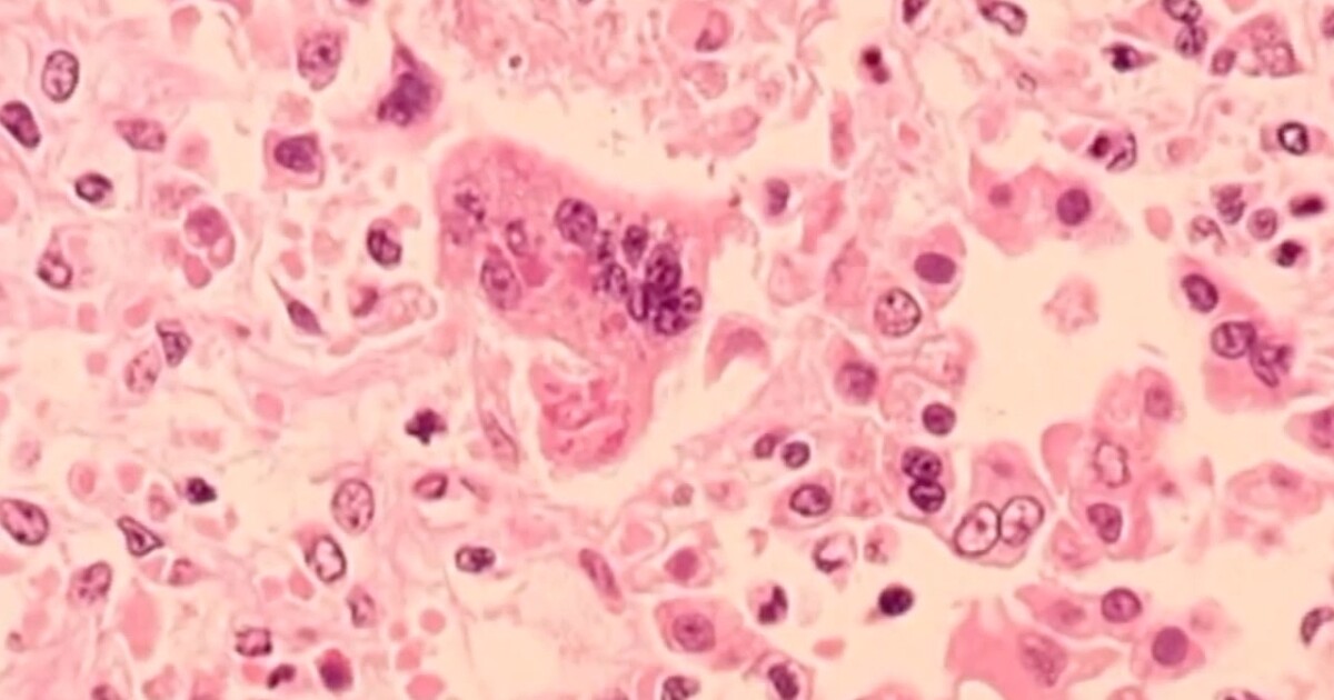 Oakland County child diagnosed with measles, per Health Division - WXYZ Channel 7