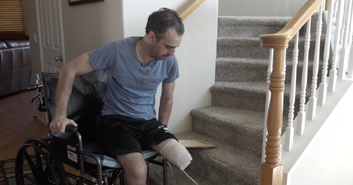 Santee crash survivor looks toward future after life-altering amputations