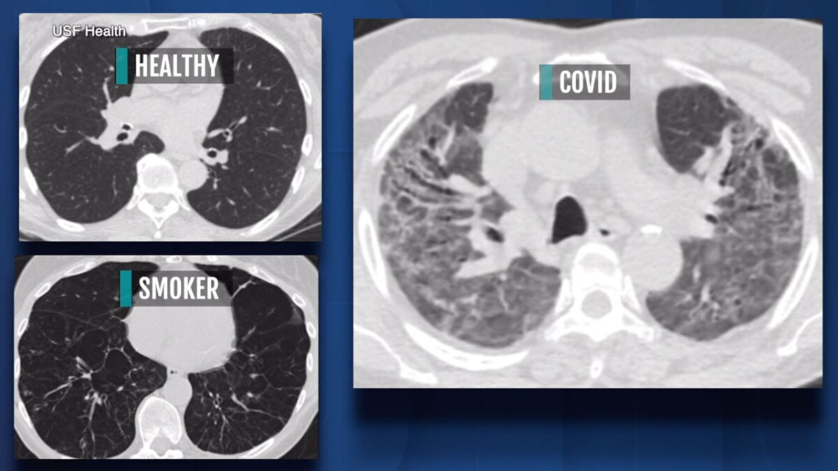 tobacco vs covid The controversial effect of smoking and nicotine in SARS-CoV-2 infection | Allergy, Asthma & Clinical Immunology Changes in Sales of Tobacco