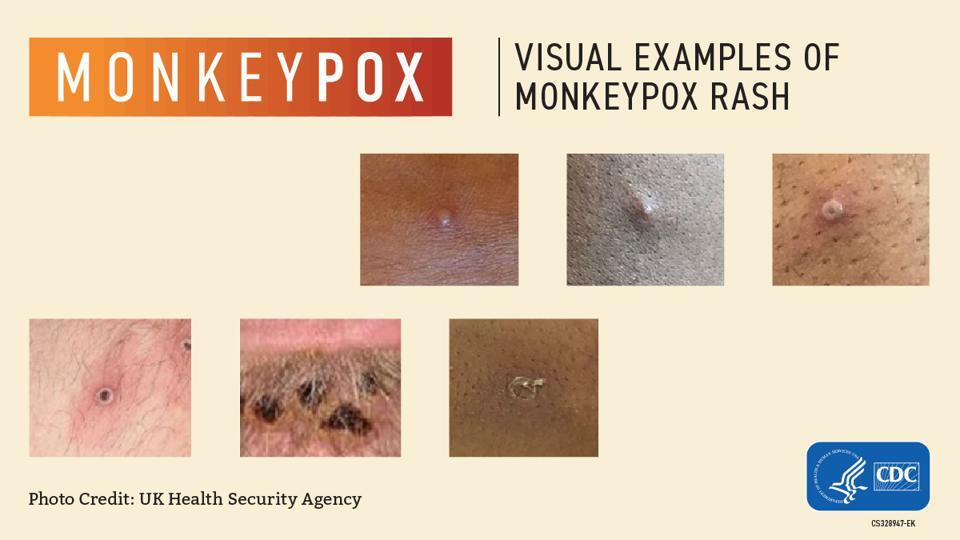 Monkeypox How it spreads and how to avoid it