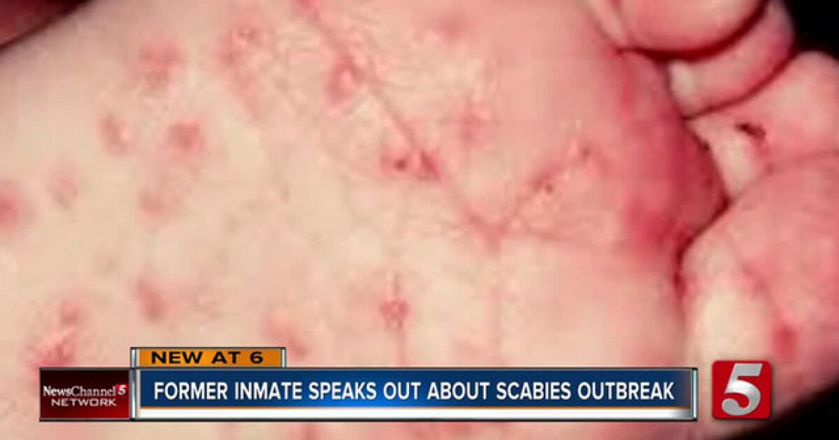 Former Inmate Talks About Scabies Corecivic S Response