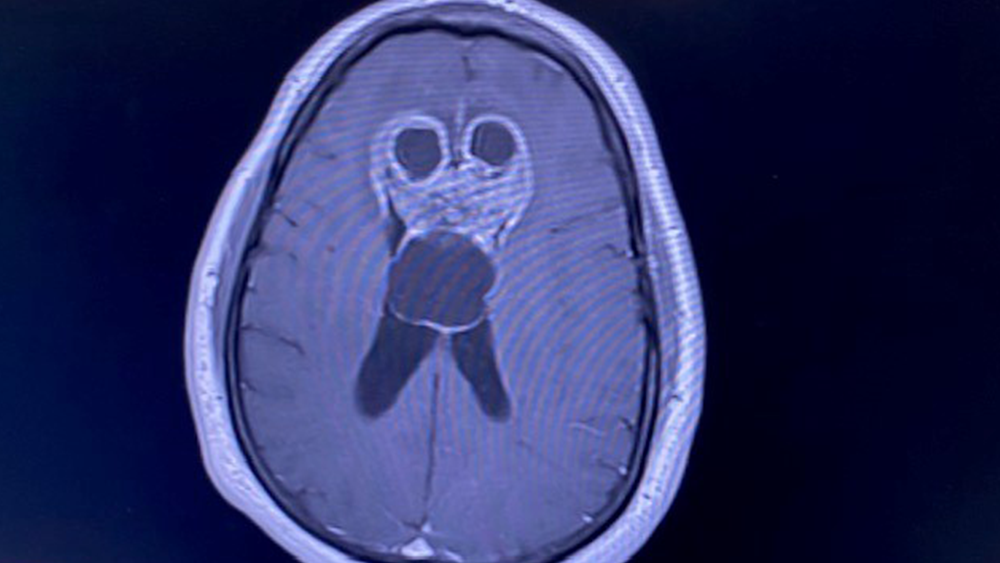 brain-tumor.png