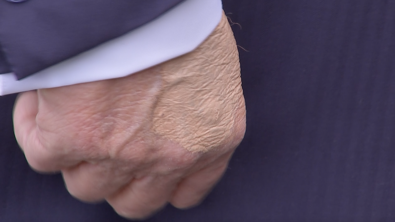 What appears to be makeup covering marks on President Donald Trump's hand as he speaks to reporters.