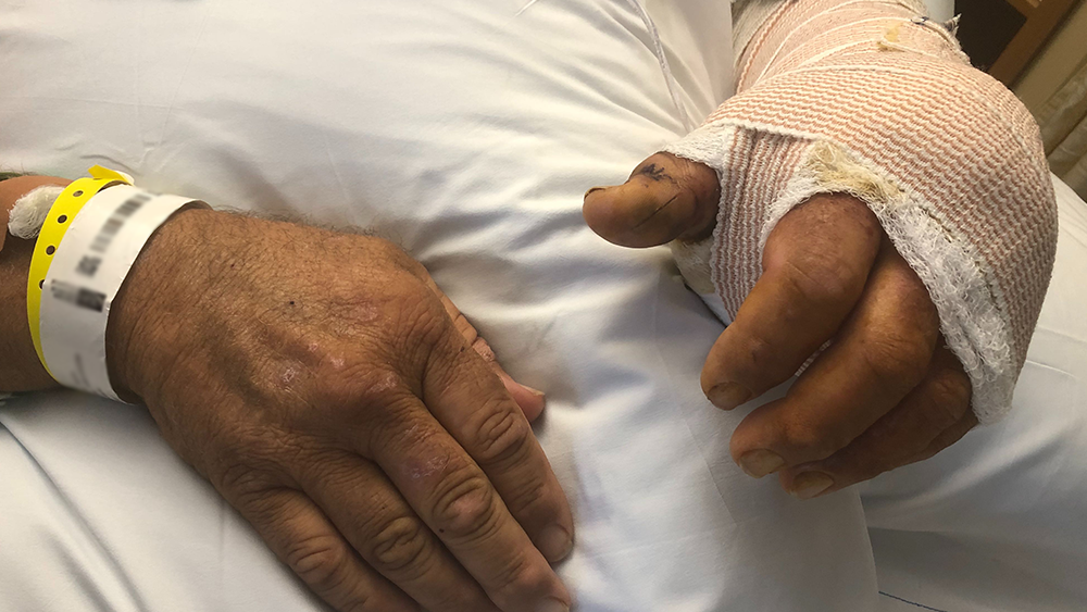 mike-walton-flesh-eating-bacteria-florida.png