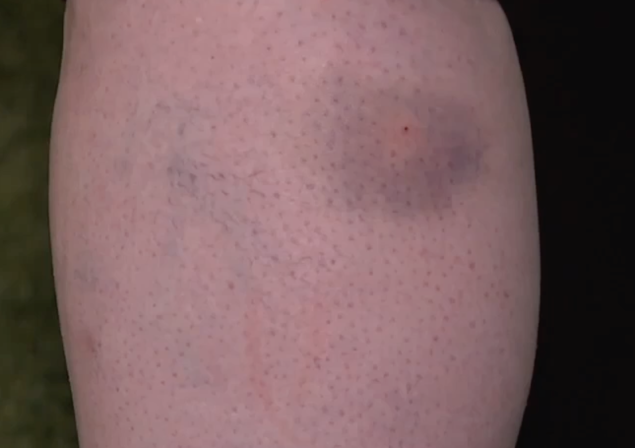 Mosquito bite on leg - 7/3/24