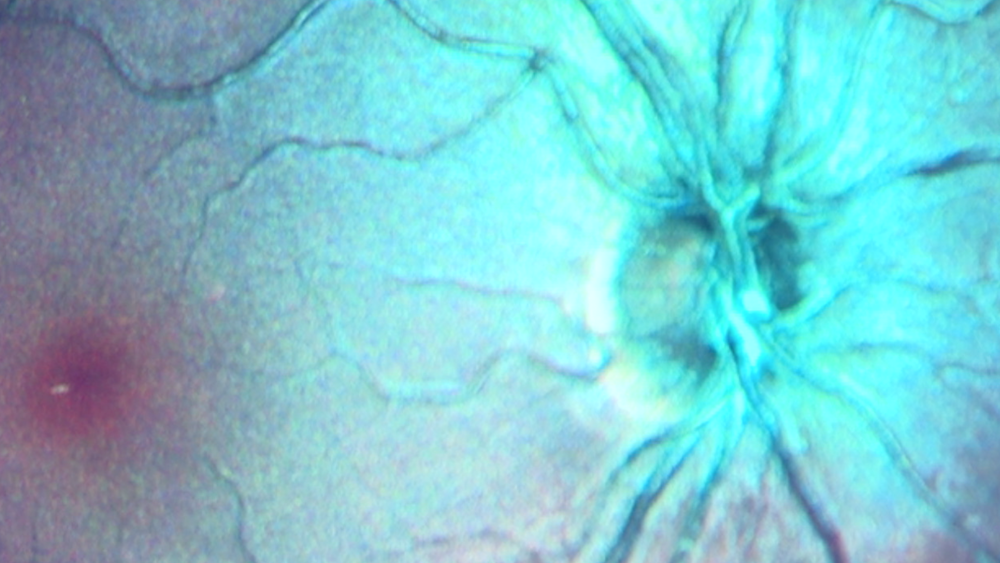 eye-exam-to-detect-Alzheimer's-sooner.png