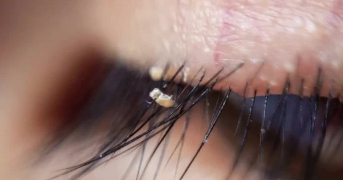 Doctors warn of lice found in eyelash extensions