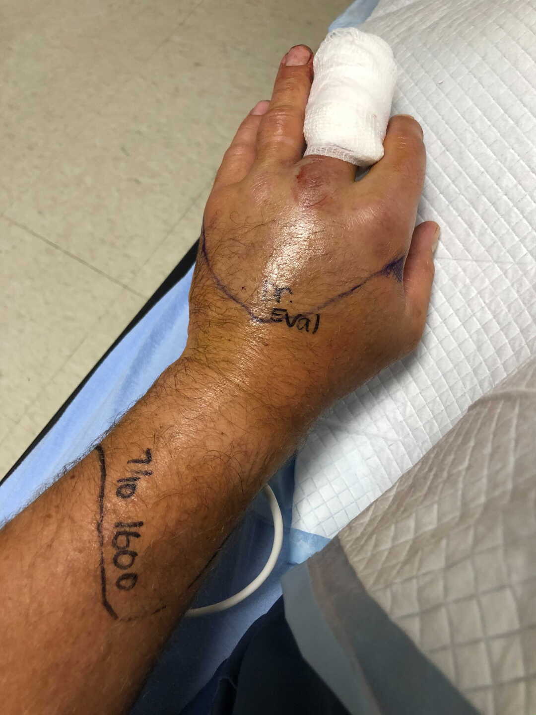 Snake Bite