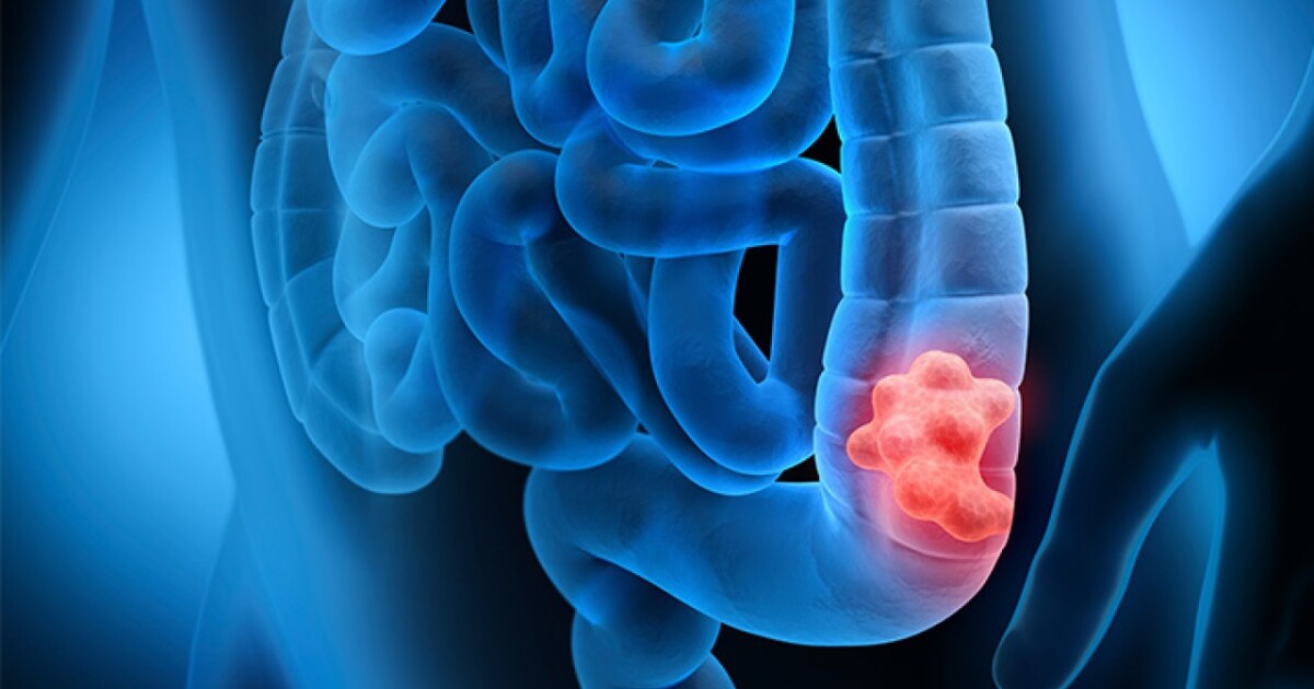 “There really is no excuse” to avoid being screened for colorectal cancer, according to local experts