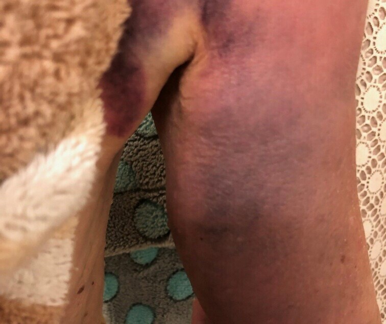 Injured Arm