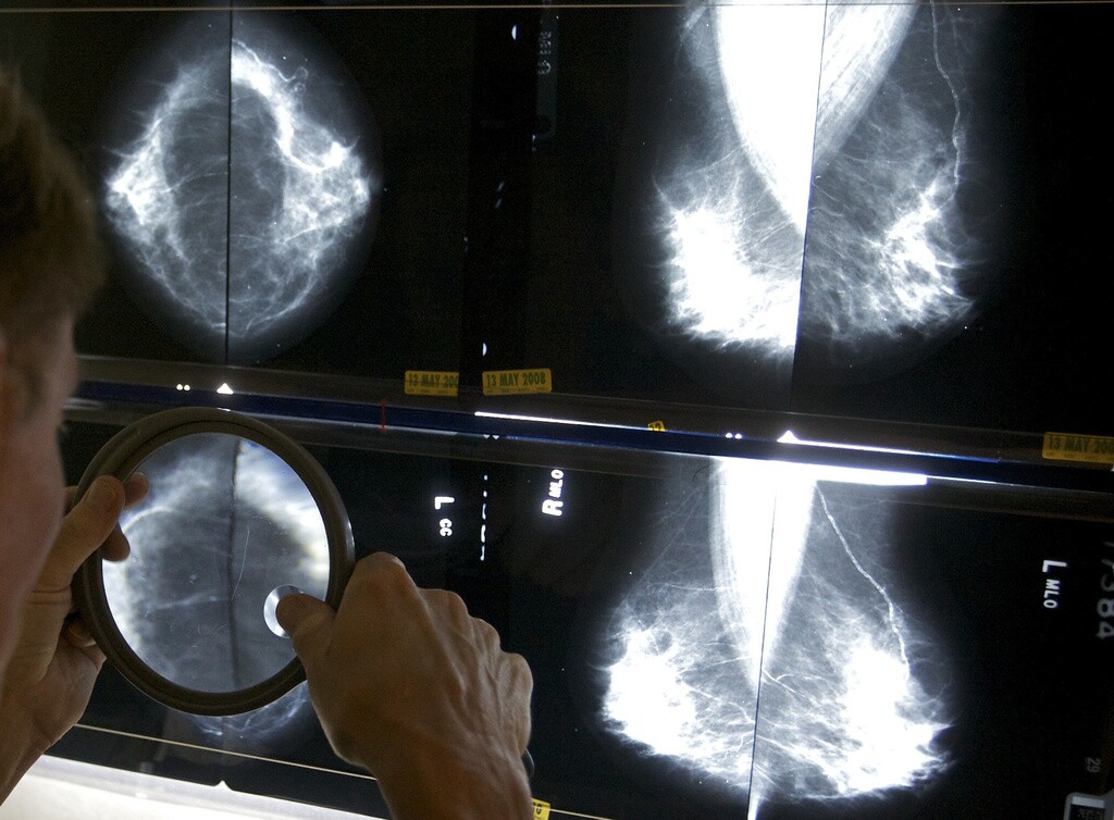 A radiologist uses a magnifying glass to check mammograms for breast cancer.