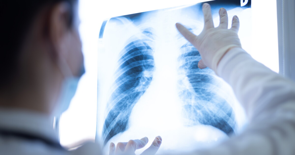 Lung cancer is the leading cause of cancer death, but advocates say early screening could save lives