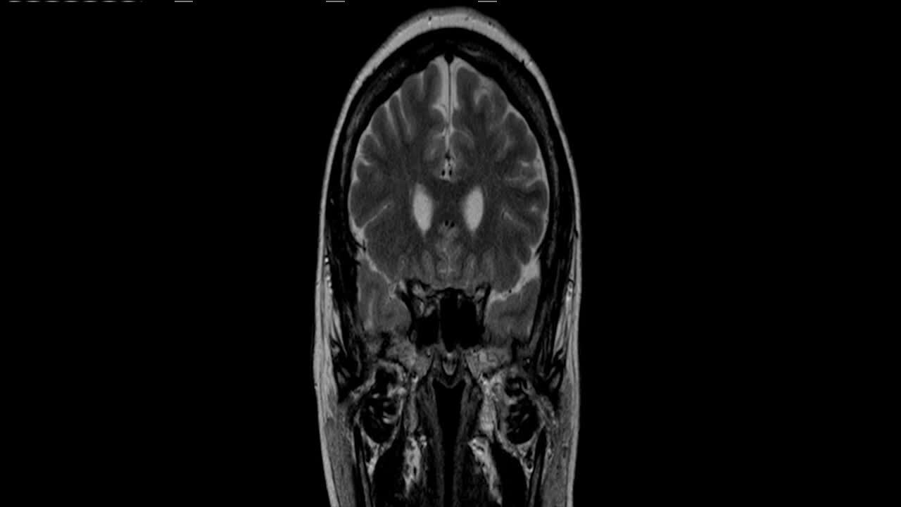 The continuing fight for a cure to Parkinson's