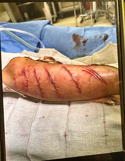 Treyson's Stitches