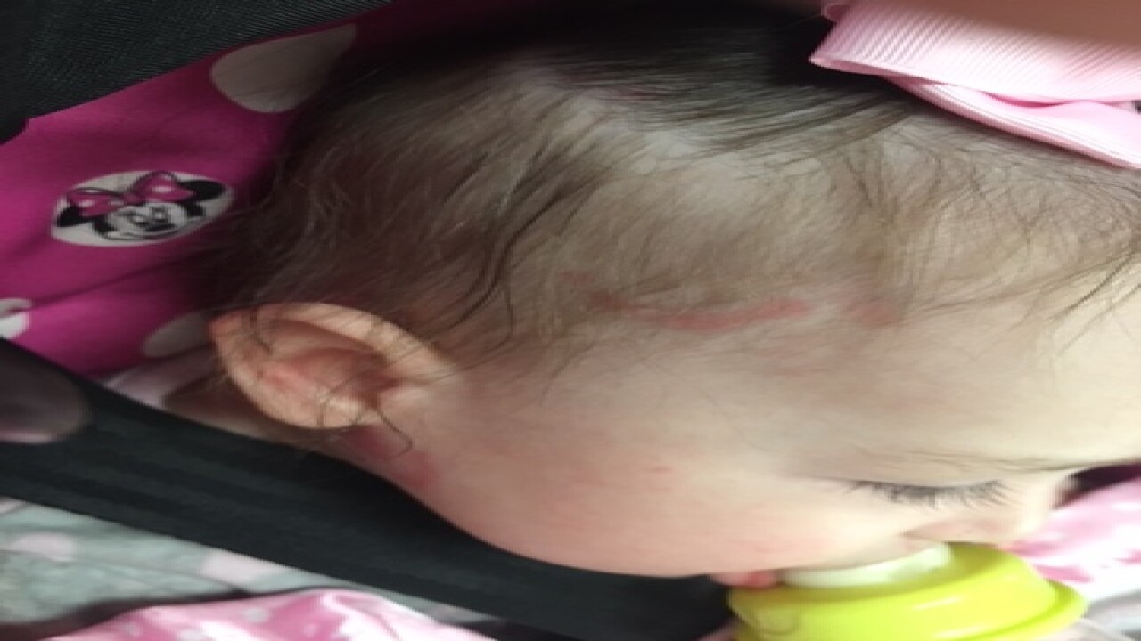PHOTOS: Baby leaves daycare with several bruises