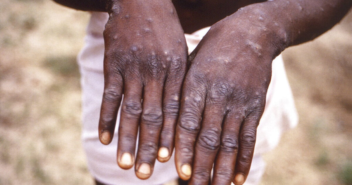 San Diego doctor urging patients to use caution as mpox breakthrough cases rise - Vimarsana News