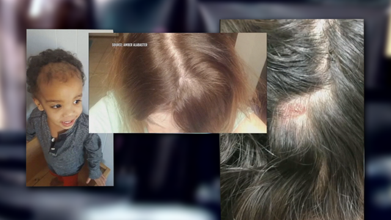 Hundreds Across The Country Say Monat Shampoo Caused Balding