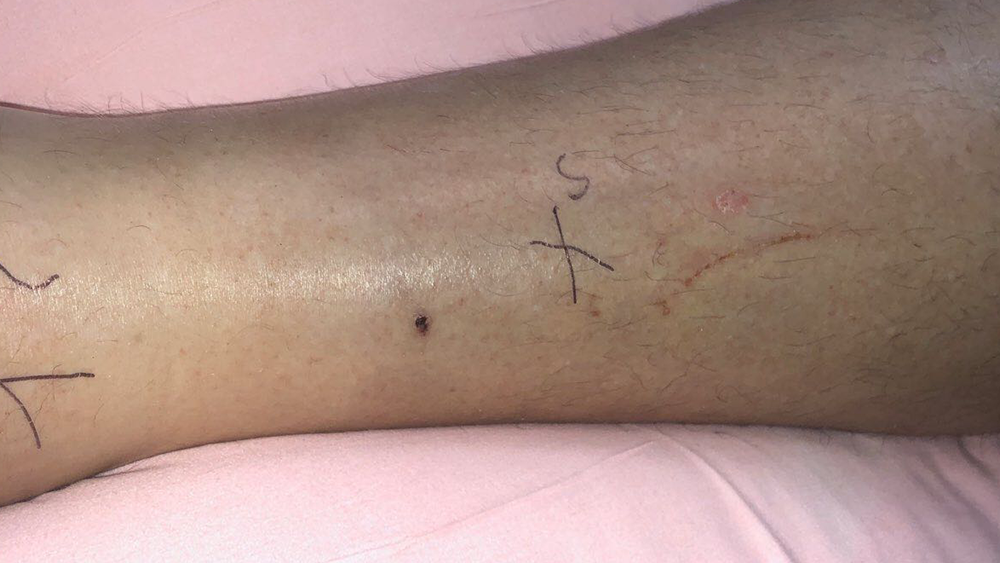 RATTLESNAKE-BITE-EARL-HJERTSTEDT-001.png