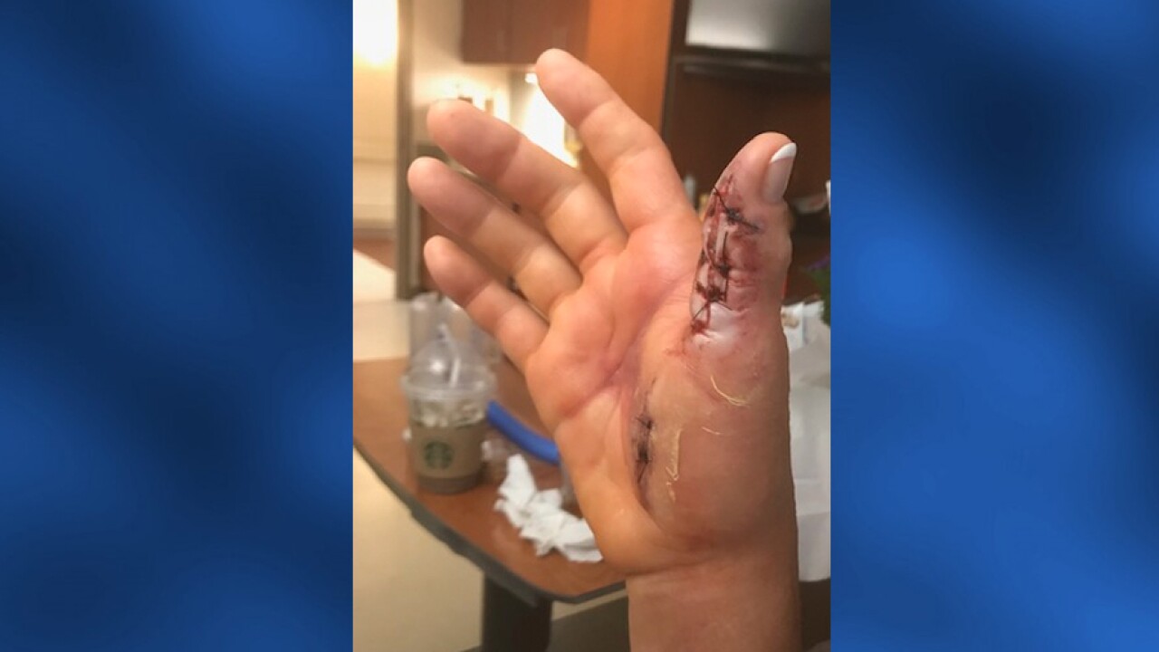 Tennessee Woman Almost Loses Her Hand Says She Contracted Flesh Eating Bacteria From Nail Salon