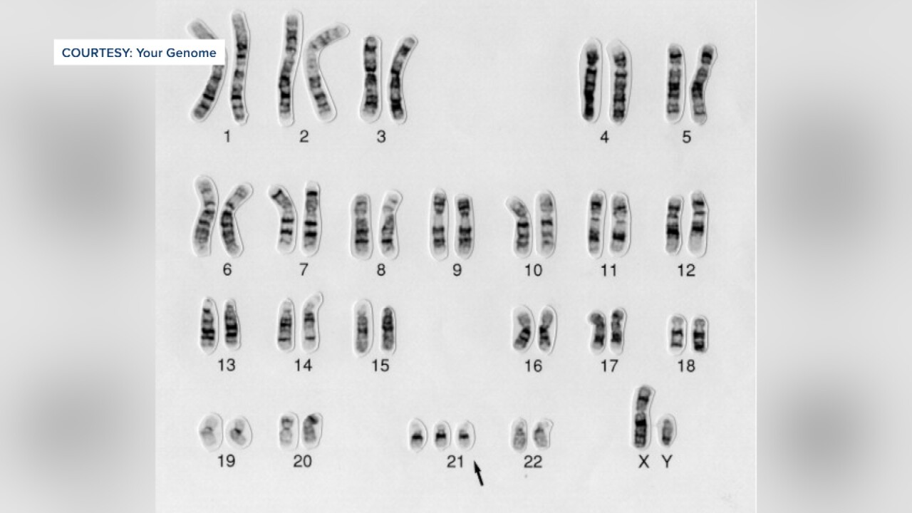 According to Your Genome, this is a photo of someone with trisomy 21.