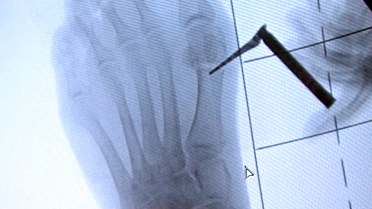 wptv-bunion-surgery-paley-center.jpg
