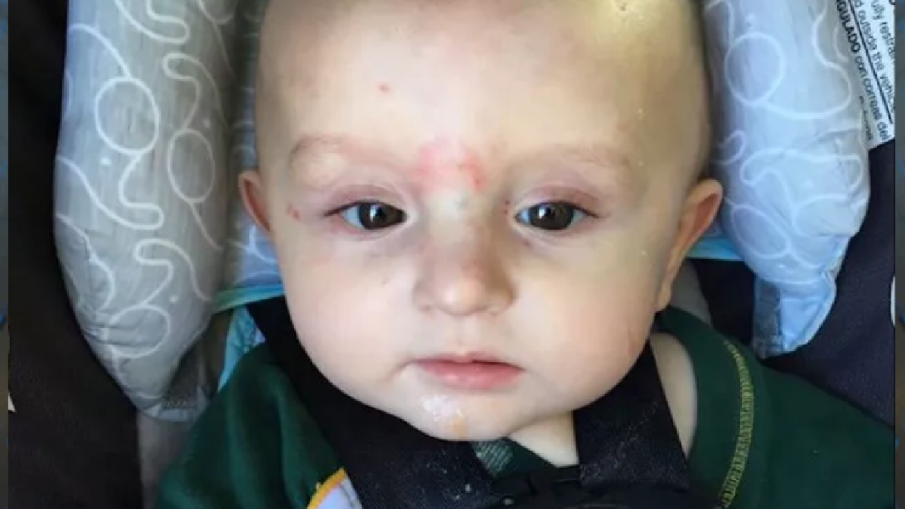 Baby Bitten And Scratched After Being Left With well known Biter At Daycare Baby Bitten And Scratched After Being Left With well known Biter At Daycare