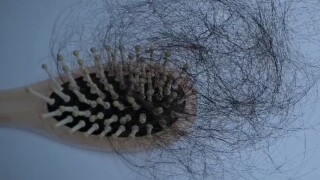 People experiencing hair loss related to COVID-19 pandemic