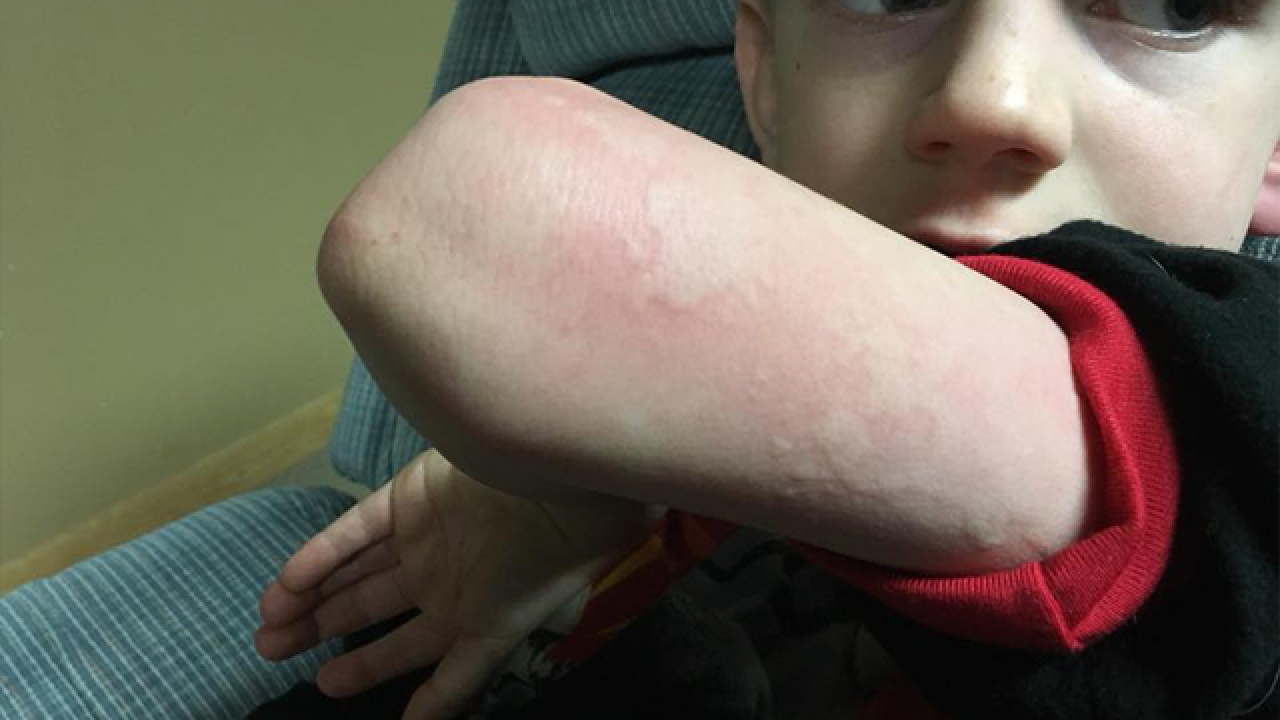 Mother warns parents after son with hives, no flu symptoms, tests positive for influenza Mother warns parents after son with hives, no flu symptoms, tests positive for influenza