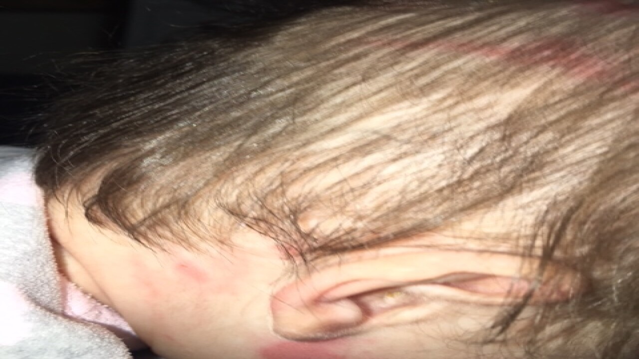 PHOTOS: Baby leaves daycare with several bruises