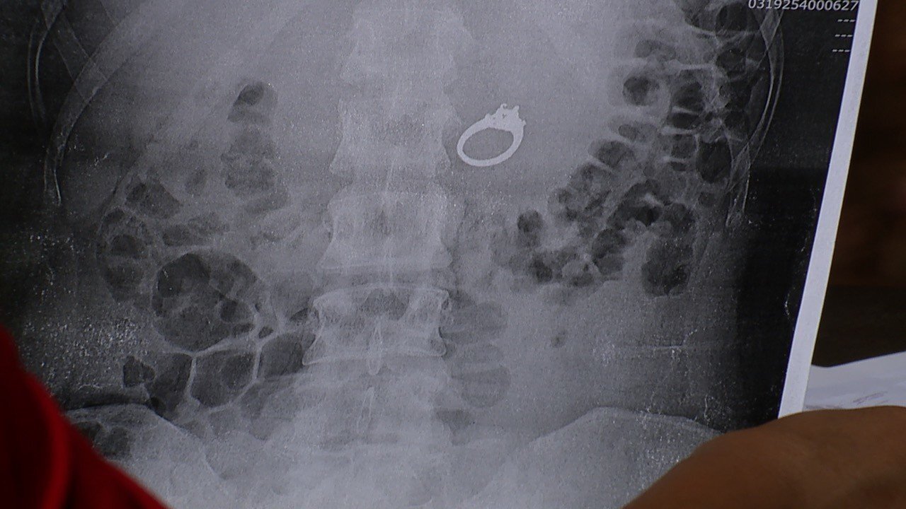 KGTV Swallowed Ring