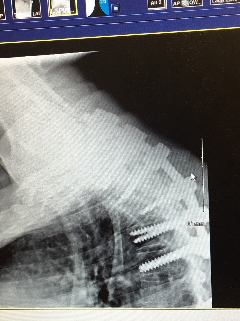 WCPO julie patrick x-ray injury.jpg