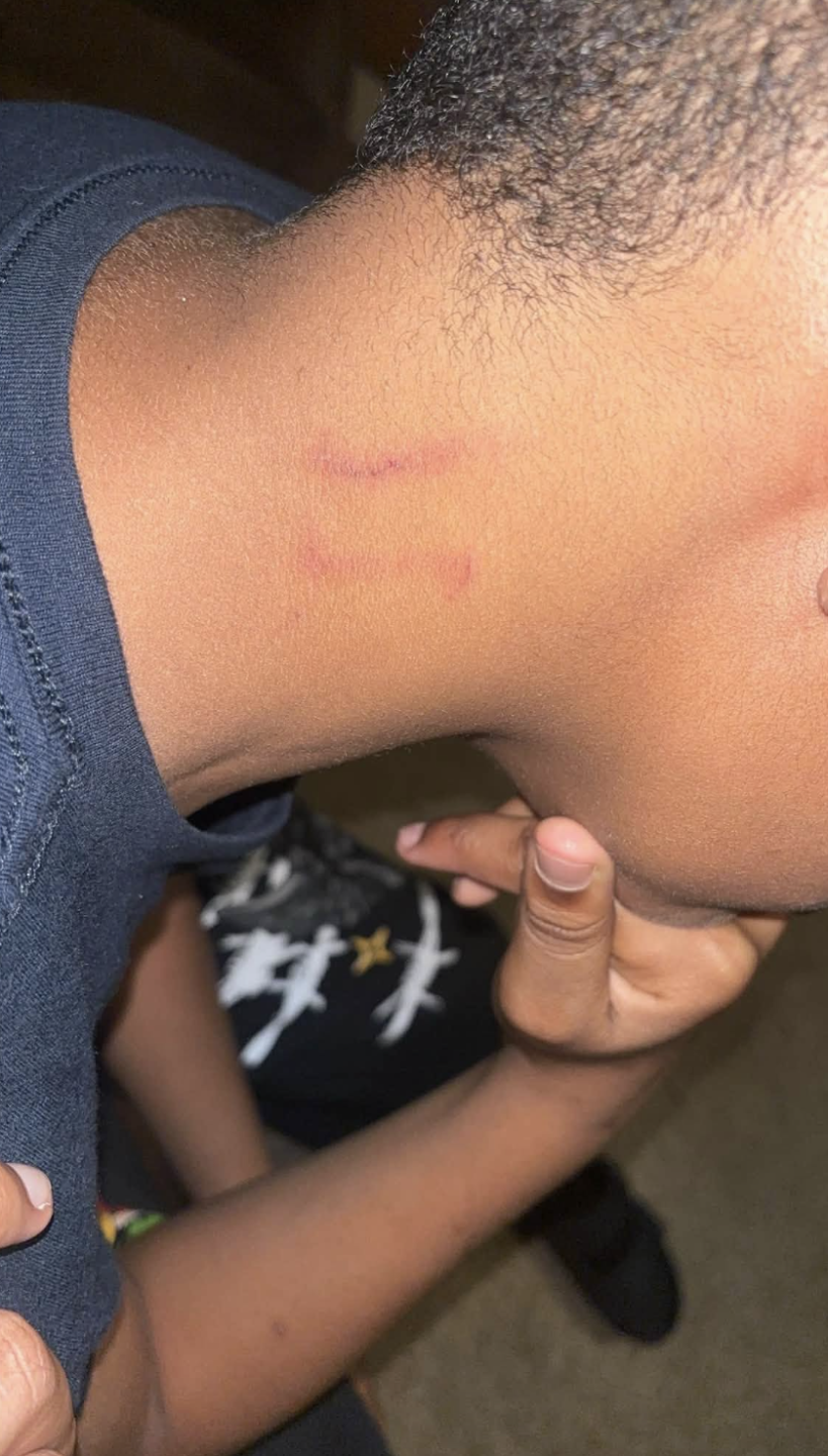 Scratch marks on her son