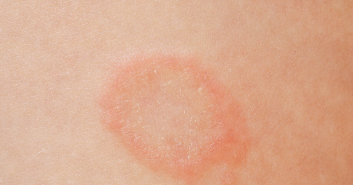 Ringworm At First Sexually transmitted ringworm reported in US for the first time