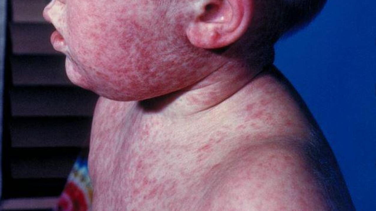 MEASLES