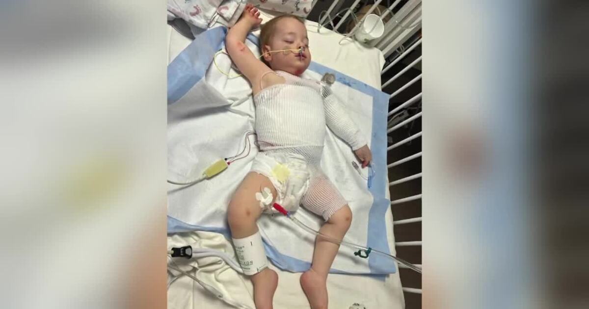 Ekalaka child severely burned in freak accident