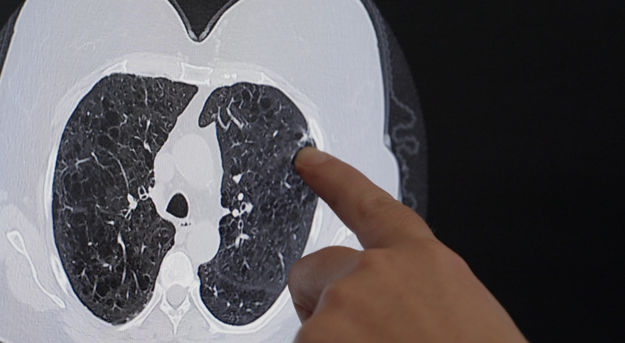 lung cancer screening.png