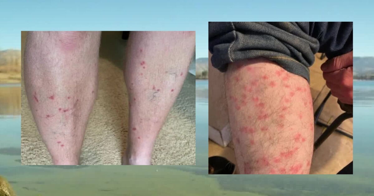Lake Crab Rash Health officials warn of 'swimmer's itch' in Utah lakes and ponds
