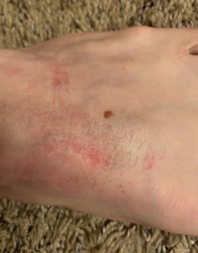 Photo of Jesse Franklin's foot